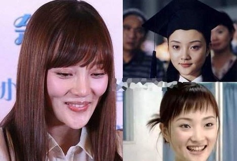 李小璐等女星整容后遗症